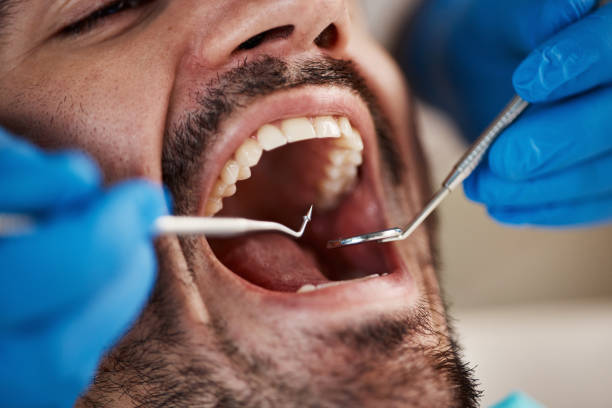 Best Emergency Wisdom Tooth Extraction in Roswell, GA